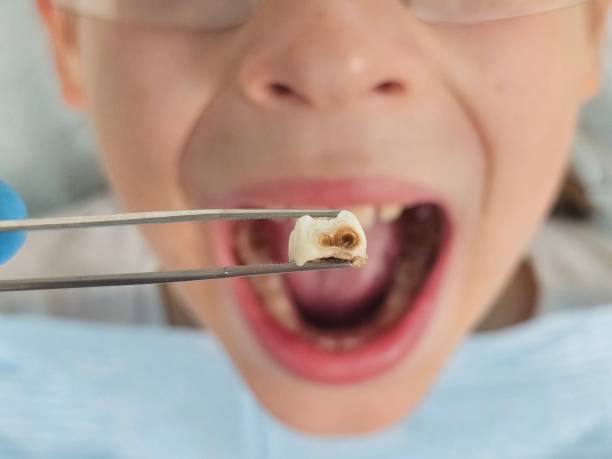 Best Emergency Wisdom Teeth Removal in Austintown, OH
